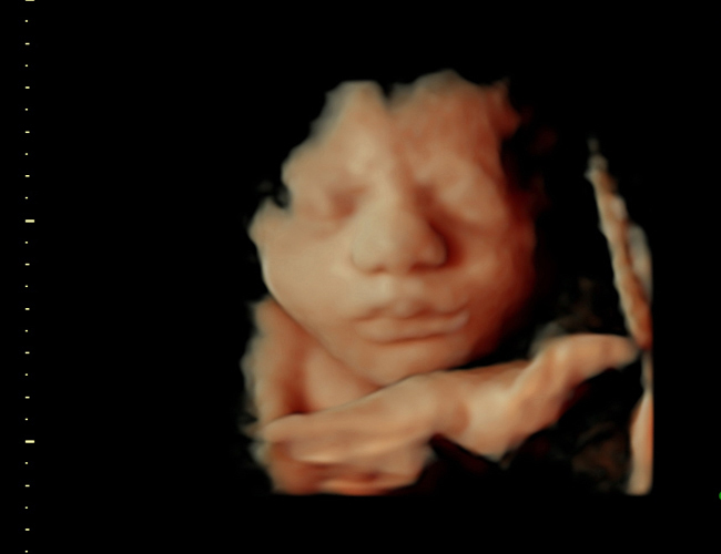 3D ultrasound image at 31 weeks